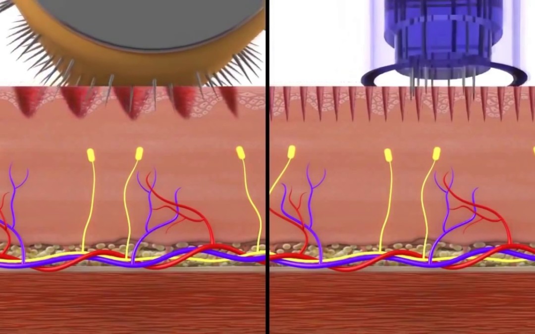 The effects of microneedling with a pen v a roller
