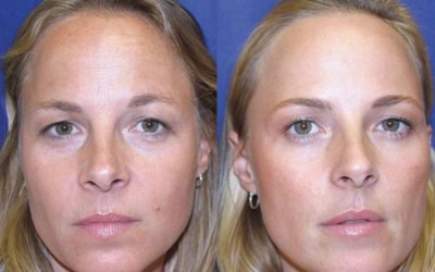 A Botox study on identical twins.